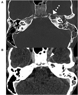 Case Report: Petrous Apicitis and Otogenic Thrombosis of the Cavernous Sinus in a 10-Year-Old Boy